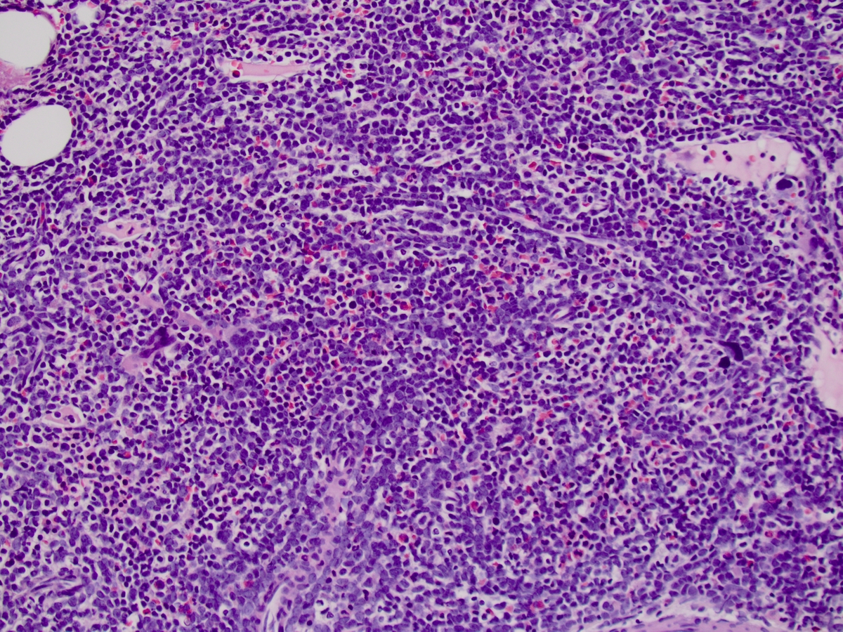 Sheets of blasts and scattered atypical megakaryocytes